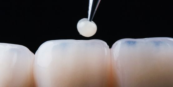 Restauración Dental